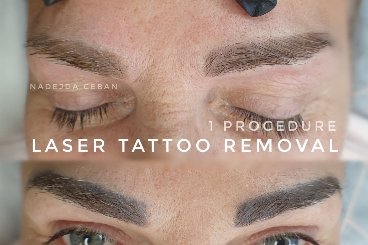 ПРЕМАХВАНЕ НА ТАТУИРОВКИ, ПЕРМАНЕНТЕН ГРИМ, МИКРОБЛЕЙДИНГ В БУРГАС